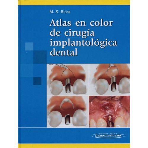 Atlas En Color de Cirurgia Implantológica Dental