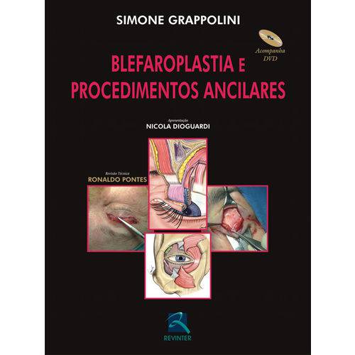 Blefaroplastia e Procedimentos Ancilares