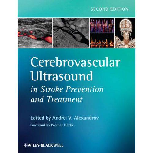 Cerebrovascular Ultrasound In Stroke Prevention An