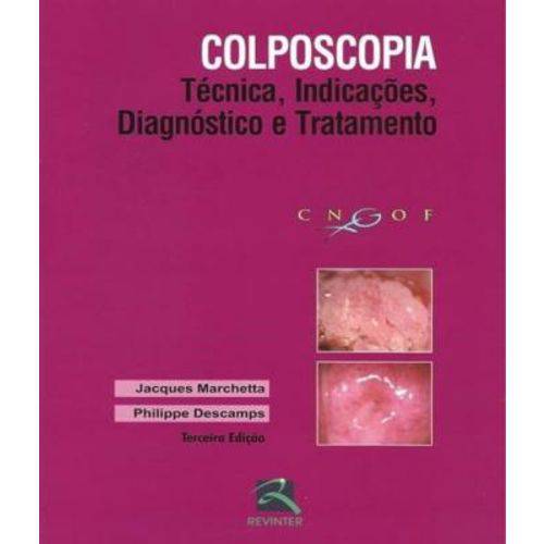 Colposcopia - Tecnica, Indicacoes, Diaginostico e Tratamento - 03 Ed