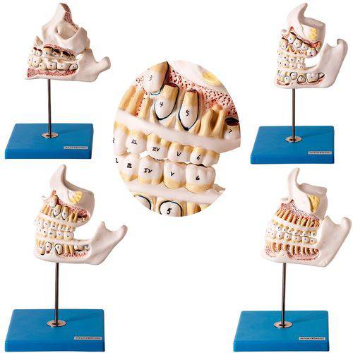 Dentição em 4 Peças Desenvolvimento dos Dentes Modelo Anatômico