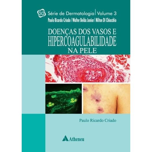 Doencas dos Vasos e Hipercoagulabilidade na Pele Vol 3 - Atheneu