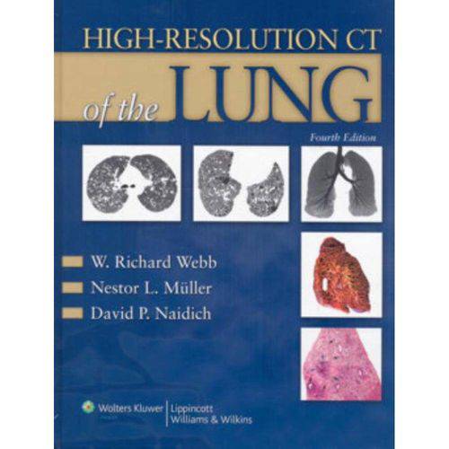 High-resolution Ct Of Lung - 4th Ed