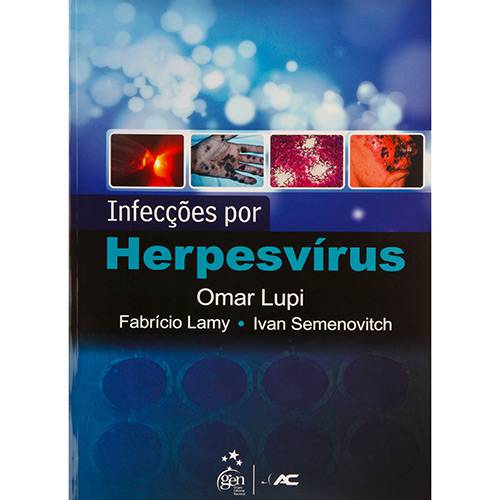 Infecções por Herpesvírus