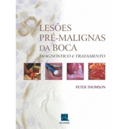 Lesoes Pre Malignas da Boca - Revinter