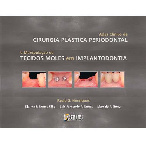 Livro - Atlas Clínico de Cirurgia Plástica e Manipulação de Tecidos Moles em Implantodontia