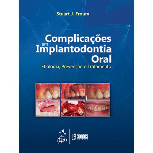 Livro - Complicações em Implantodontia Oral: Etilologia, Prevenção e Tratamento
