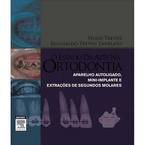 Livro - Estado da Arte na Ortodontia, o - Aparelho Autoligado, Mini-Implante e Extrações de Segundos Molares