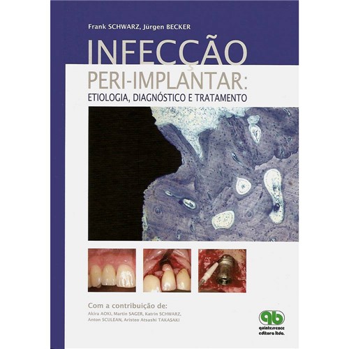 Livro - Infecção Peri-Implantar - Etiologia, Diagnóstico e Tratamento