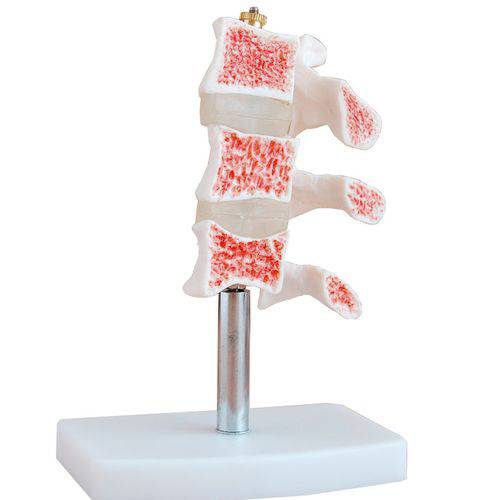 Modelo de Osteoporose - Coleman - Cód: Col 1134