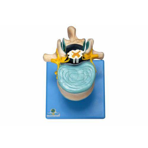 Vértebra Lombar C/Cordão Espinhal, Nervo e Cauda Equina Modelo Anatômico
