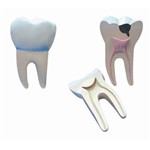 Dente Molar Ampliado - Saudável e com Cáries Anatomic - Tgd-0311-b