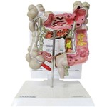 Intestino Grosso Patológico Anatomic - Código: Tgd-0329-g