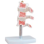 Modelo de Osteoporose - Coleman - Cód: Col 1134