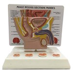 Modelo de Próstata
